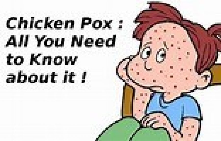 chicken pox jokes